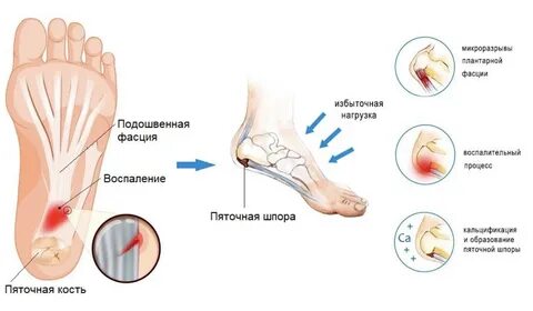 6 упражнений для лечения подошвенного фасциита профресурс22.рф. 