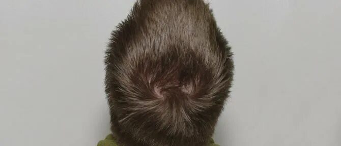 люди с 2 макушками. две макушки. две макушки. макушка головы у мужчин. две макушки на голове.