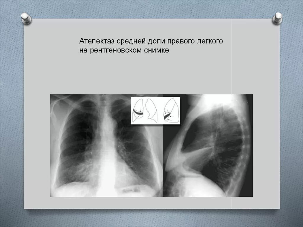 Признаки ателектаза легкого. Ателектаз средней доли правого легкого рентген. Ателектаз средней доли легкого рентген. Ателектаз доли рентген. Компрессионный ателектаз лёгкого.