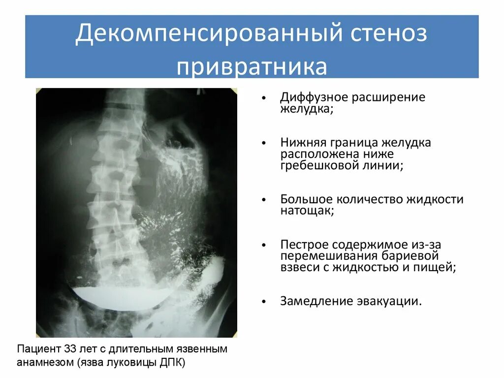 Осложнения стеноза