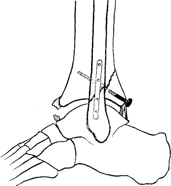 перелом заднего края большеберцовой кости. апикальный краевой перелом лодыжки. перелом заднего края таранной кости. задний край со смещением большеберцовой. перелом малой берцовой кости.