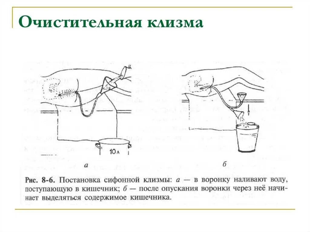 Сколько ставить клизму. Техника постановки клизмы. Постановка очистительной клизмы. Необходимое оборудование для постановки очистительной клизмы.. Методика постановки очистительной клизмы.