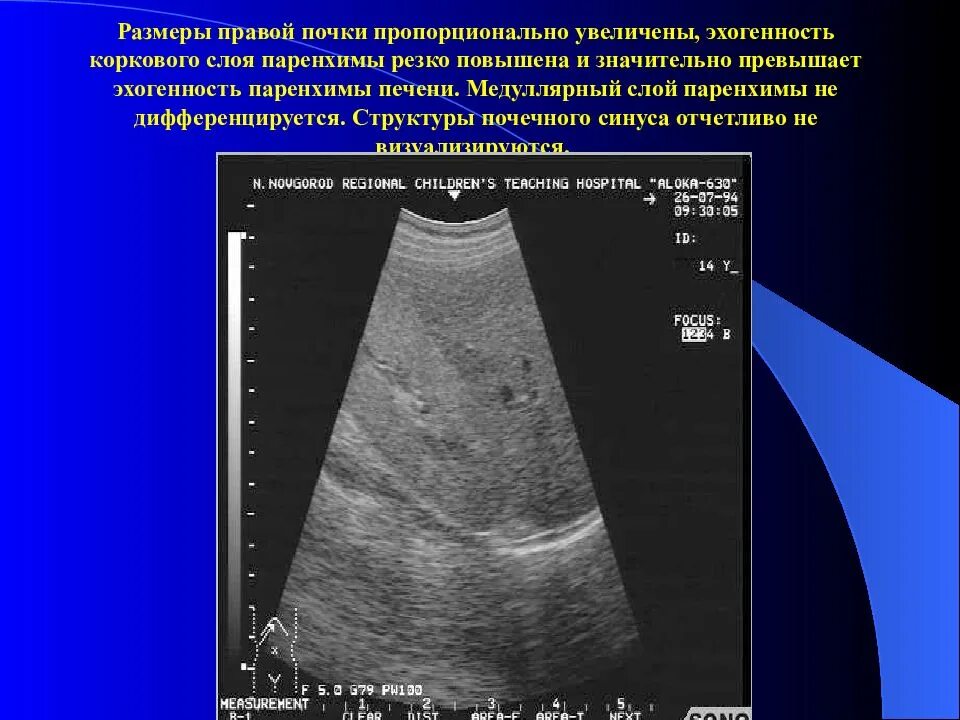 Эхоструктура паренхимы почки. Эхогенность почки паренхимы повышена. Эхогенность коркового слоя почек. Повышение эхогенности паренхимы почек на УЗИ.