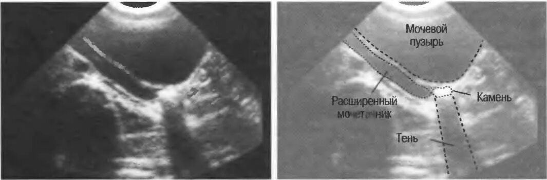 Как быстро наполнить мочевой пузырь. УЗИ мочевого пузыря Устье мочеточника. Камень верхней трети мочеточника УЗИ. Расширение устья мочеточника на УЗИ. Камень устья мочеточника на УЗИ.