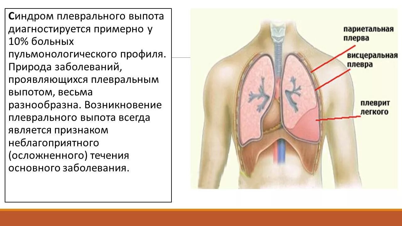 Лечение плевральной полости. Выпот в плевральной полости. Синдром плеврального выпота. Синдром выпота в плевральной полости. Транссудат в плевральной полости.