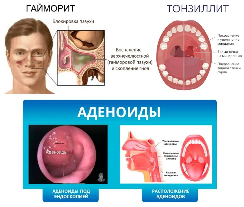 Сильно болит горло и кашель