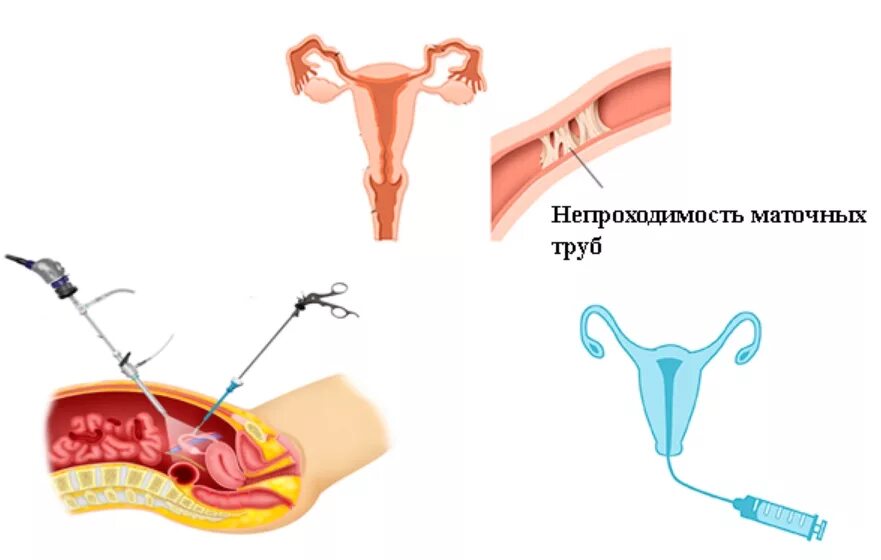 Трубы у женщин лечение. Паховая грыжа операция лапароскопия. Злокачественные новообразования яичников. Трубы у женщин лечение. Трубы у женщин лечение.
