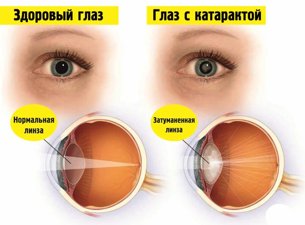 Когда восстанавливается зрение после замены хрусталика. Помутнение хрусталика глаза. Как выглядит помутнение хрусталика. Помутнение хрусталика глаза как называется.