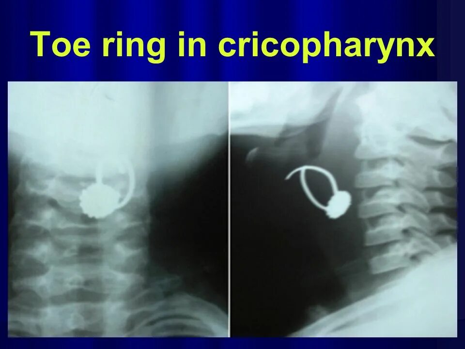 Таблетка застряла в пищеводе. Инородное тело пищевода рентген. Инородное тело в дыхательных путях у ребенка рентген. Инородное тело гортани рентген. Инородное тело в трахее рентген.