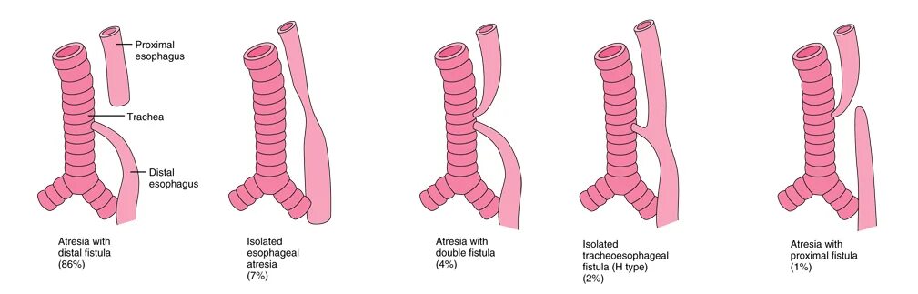 Атрезия пищевода с трахеопищеводным свищем ?. Атрезия пищевода у детей рентген. Пищевод у новорожденного