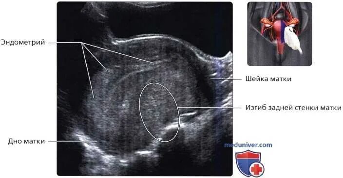 Ультразвуковая анатомия матки. Нормальное положение матки на УЗИ. Узи при миоме матки на какой день