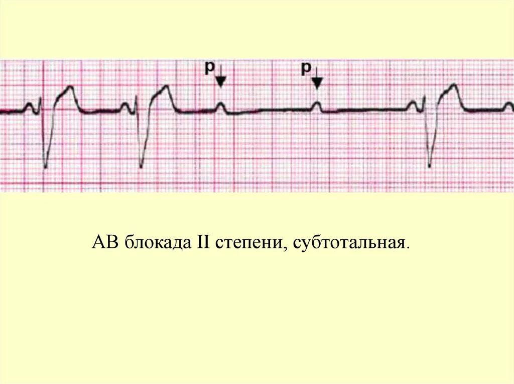 Полная атриовентрикулярная блокада. АВ блокада 1 степени на ЭКГ. АВ блокада 3 степени на ЭКГ. АВ блокада 2 степени 3 к 1. Далекозашедшая АВ блокада 1 степени.