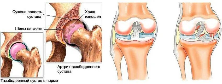 Как восстановить связки коленного сустава. Артроз связки тазобедренного сустава. артроз коленного и тазобедренного сустава. хрящ тазобедренного сустава.