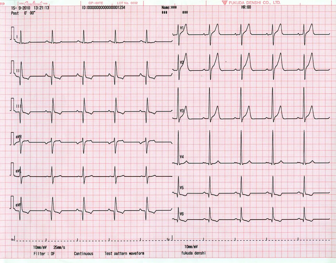 Экг сердца москва. ЭКГ норма в 12 отведениях. Пример нормальной ЭКГ. Кардиограф FX -8322/FX -8322 R. ЭКГ норма 50 мм/с.