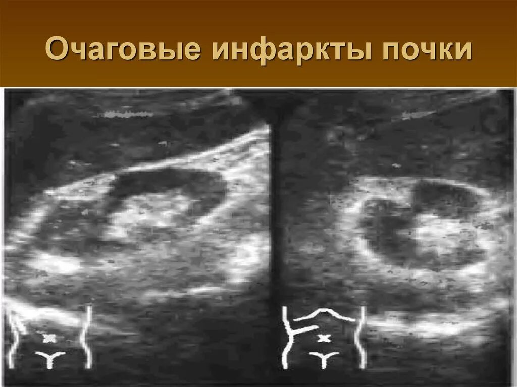 Очаговые изменения почки. Инфаркт почки диагностика. Мочекислый инфаркт почек на УЗИ.