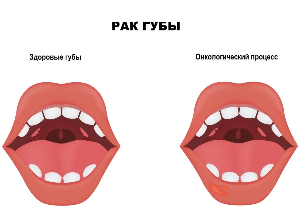 Рак губы - причины появления, симптомы заболевания, диагностика и способы лечени