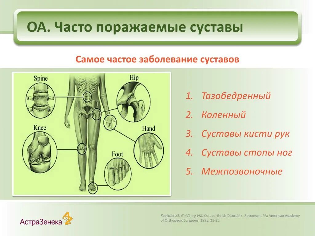 Суставы наиболее часто поражаются при. При остеоартрозе наиболее часто поражаются суставы. суставы поражающиеся при остеоартрозе. укажите суставы, наиболее часто поражаемые при остеоартрозе. сустав человека рисунок.