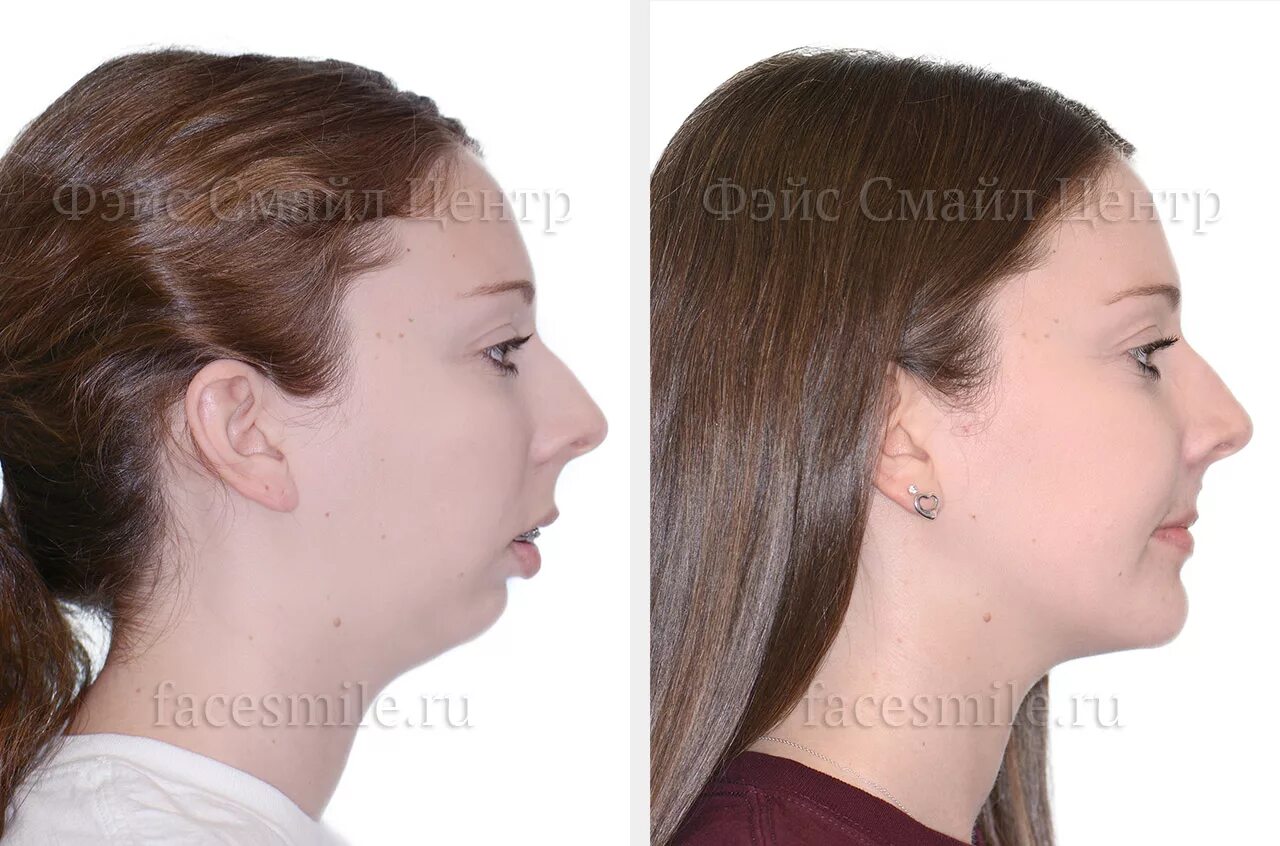 Неправильный прикус дистальный. Глубокий дистальный прикус профиль. Ментопластика (гениопластика). Дистальный прикус профиль. Дистальный прикус и глубокий прикус.