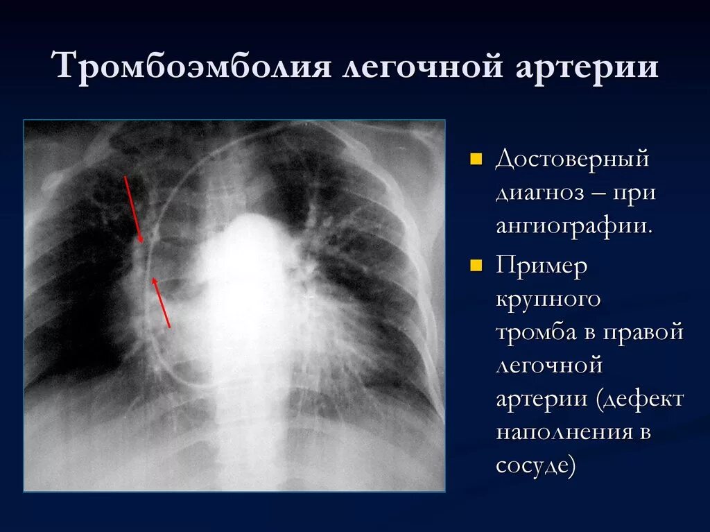 Что такое тромбоэмболия легочной артерии простыми словами. Тромбоэмболия мелких ветвей легочной артерии рентген. Массивная Тэла рентген. Рентгенодиагностика тромбоэмболии легочной артерии. Тромбоэмболия легочной артерии лучевая диагностика.