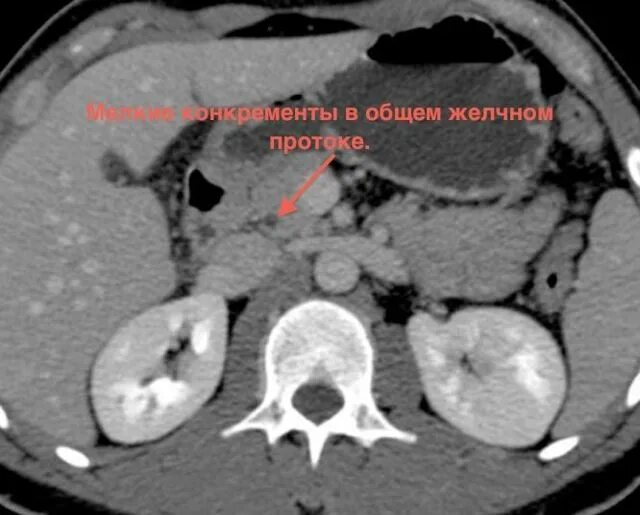Конкремент холедоха на кт. Конкременты желчных протоков кт. Конкременты желчного пузыря на кт. Камни в желчном кт