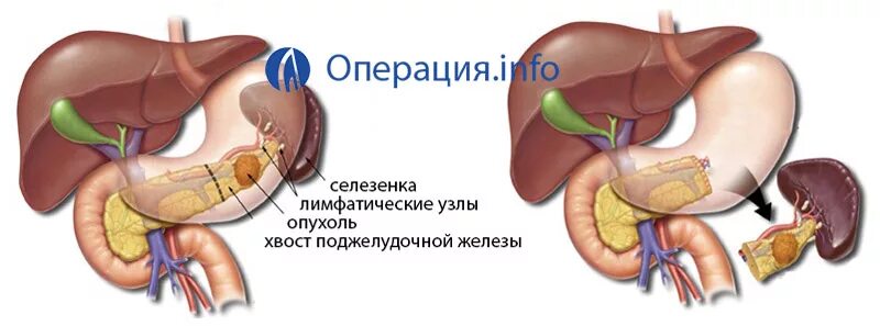 Поджелудочная железа операция отзывы. Операции при опухоли головки поджелудочной железы. Липоматоз поджелудочной железы. Дистальный отдел поджелудочной железы. Корпорокаудальная резекция поджелудочной.