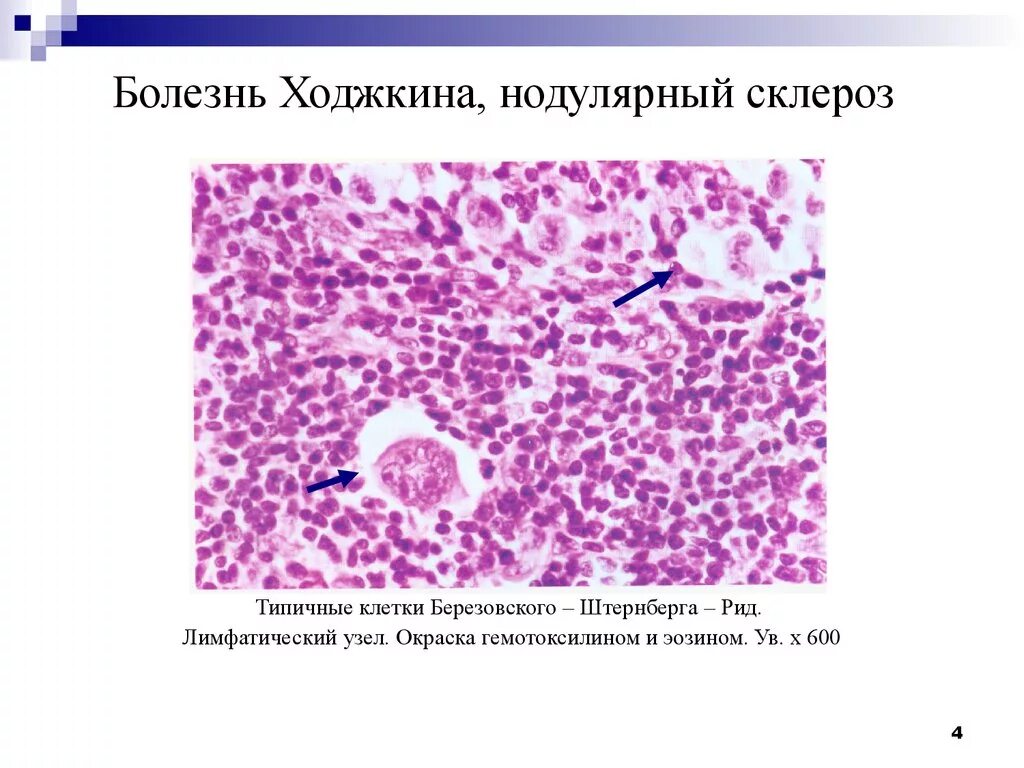 Лимфома лимфатические узлы. Лимфогранулематоз нодулярный склероз микропрепарат. Лимфатический узел при болезни Ходжкина. Микропрепарат лимфома Ходжкина нодулярный склероз. Лимфатический узел при болезни Ходжкина микропрепарат.