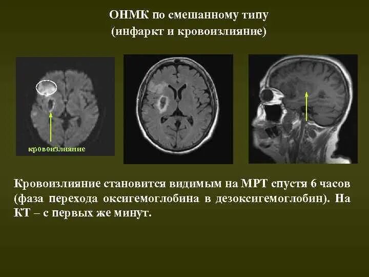 ОНМК по ишемическому типу кт. Инсульт на компьютерной томографии головного мозга. Геморрагическая трансформация ишемического инсульта кт. Кт картина при ишемическом инсульте.