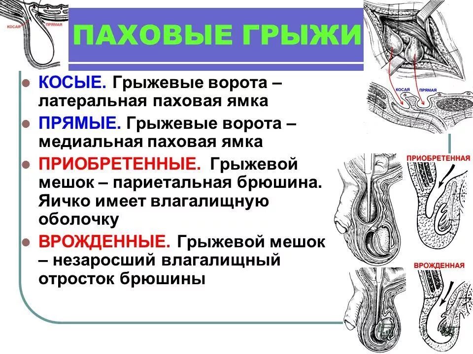 Как отличить грыжу