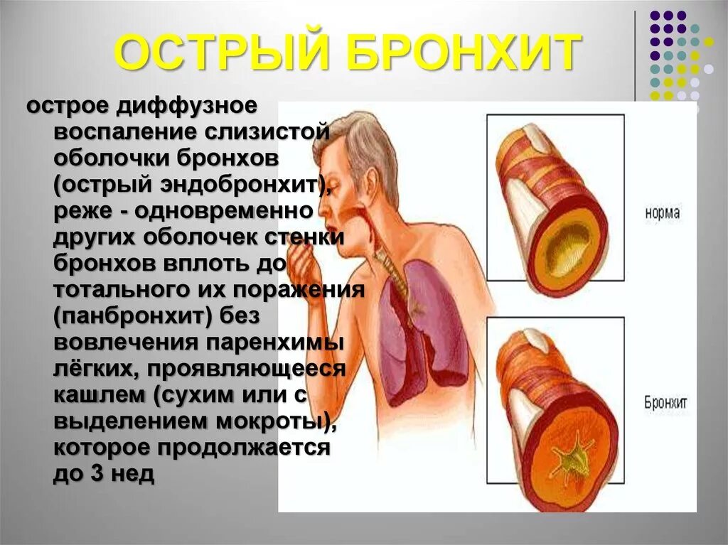 Описание бронхита. Бронхит и острый бронхит. Острое воспаление бронхов. Воспаление слизистой бронха.