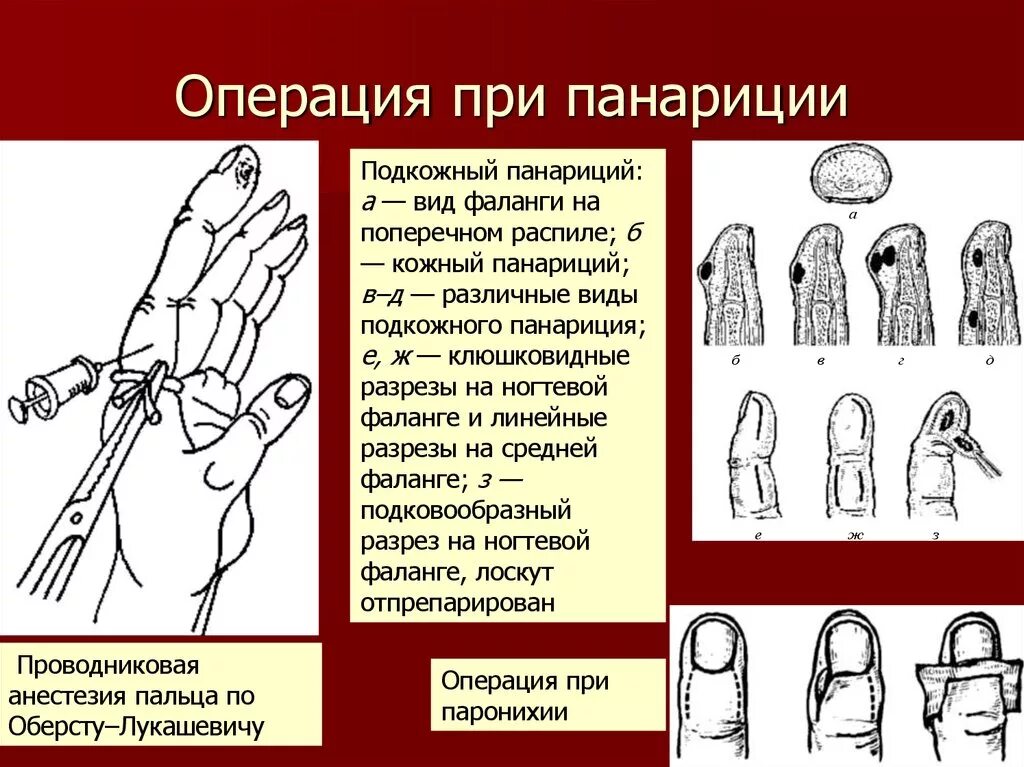 Подкожный панариций ногтевой фаланги. Вскрытие панариция ногтевой фаланги. Операция при панариции ногтевой фаланги.