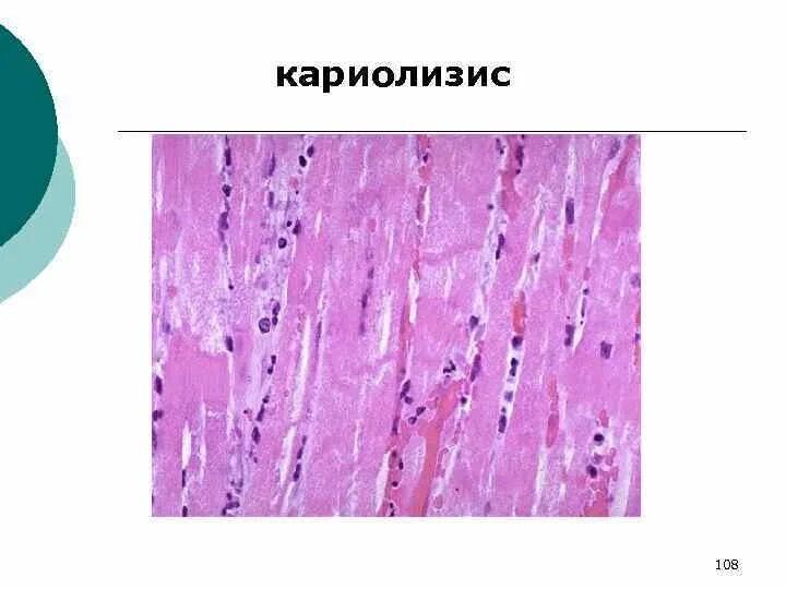 Кариопикноз это. Кариорексис кариолизис. Кариопикноз кариорексис кариолизис некроз. Кариолизис это гистология. Кариолизис микропрепарат.