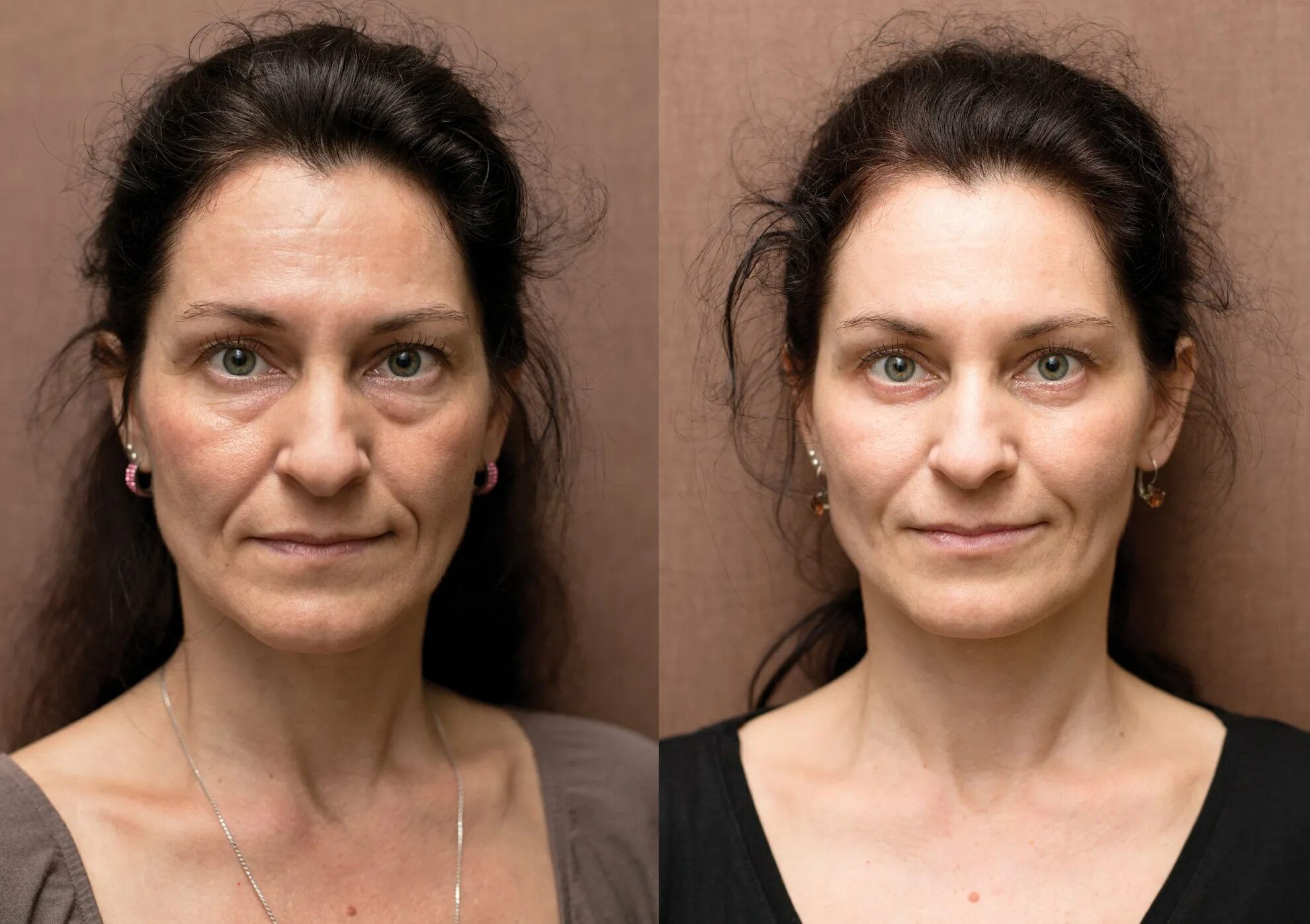 Ботокс для лица до и после. Морщины до после. Уколы красоты до и после. Девушка с морщинами. Процедура для лица после 60