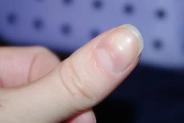 неровный ноготь на пальце руки