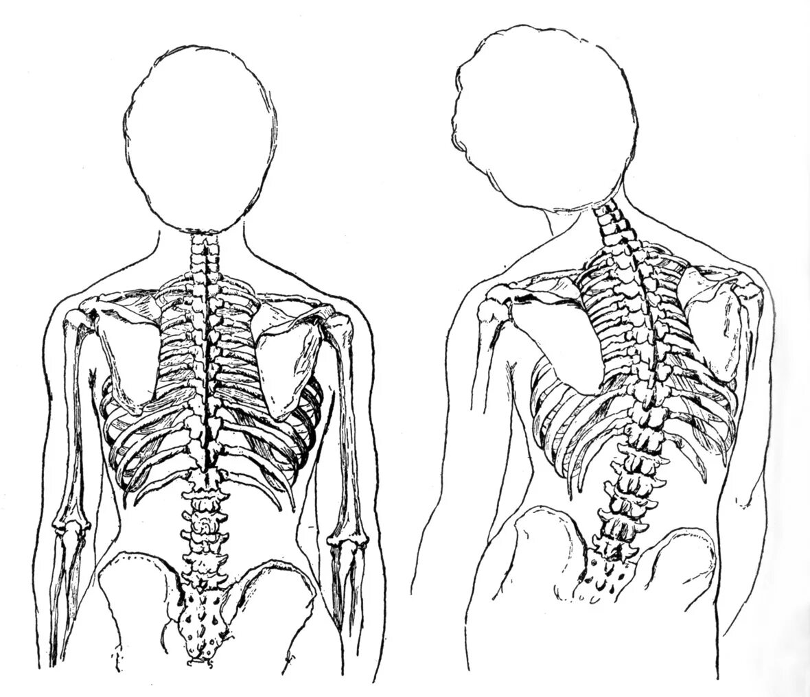 Скелет человека спина. Сколиоз позвоночника скелет. Сколиоз позвоночника схема. Скелет человека со сколиозом. Сколиоз боковое искривление позвоночника.