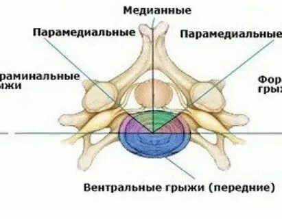 Медианно парамедианная грыжа