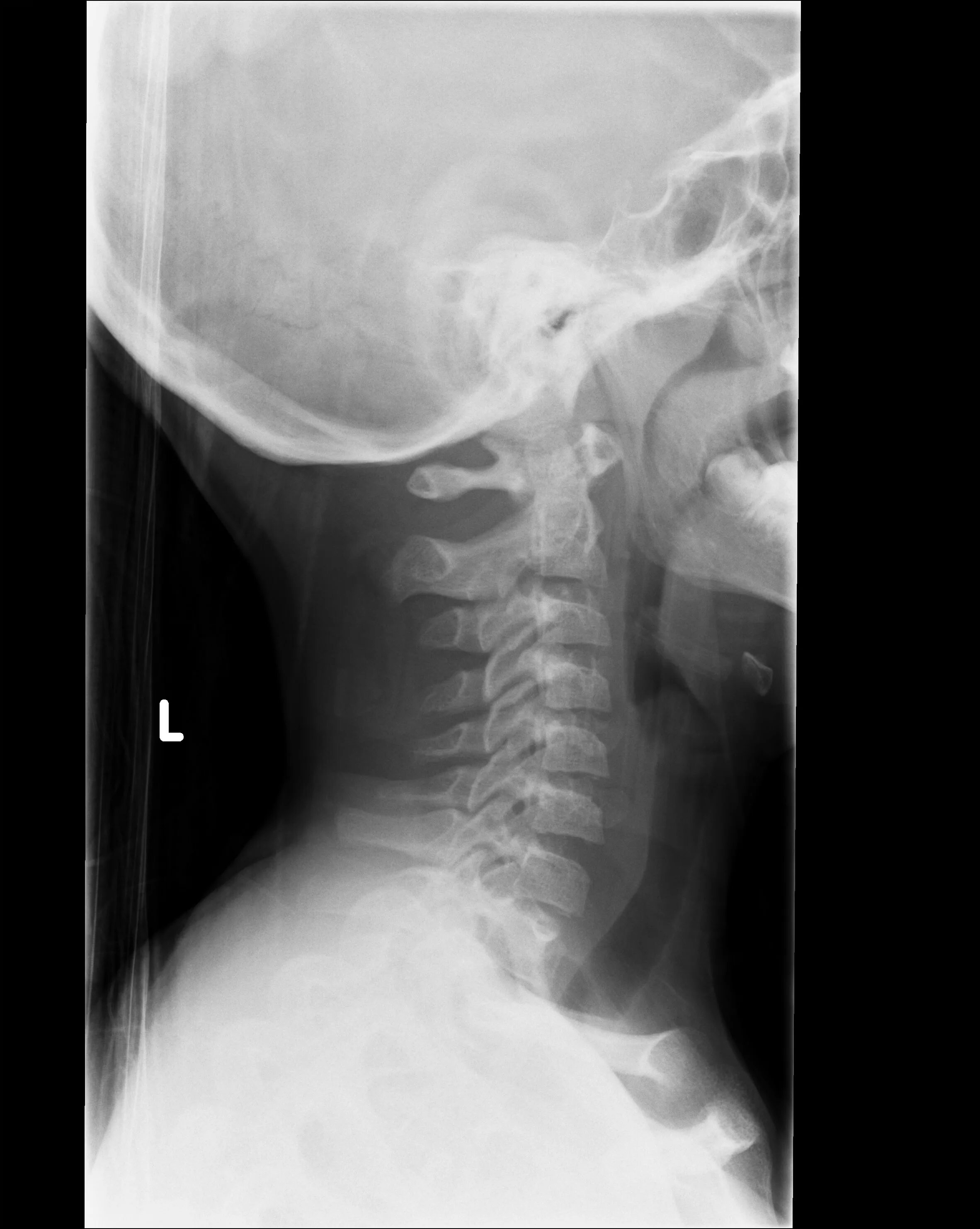 Lumbar Spine XRAY. Normal Lumbar Spine x ray. CT cervical Spine]. X ray cervical Spine. Xray extension