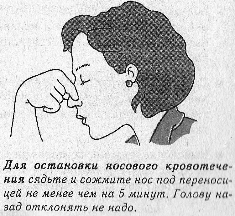 Как сделать чтобы из носа потекла. Остановка кровотечения из носа. как вызвать кровь из носа. как сделать чтобы пошла кровь из носа. как остановить кровиз носа.