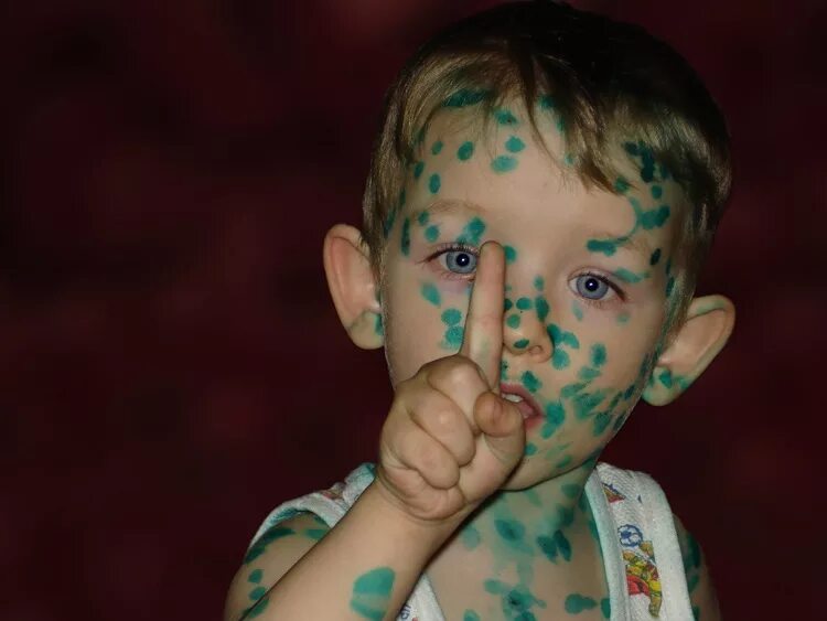 можно ли не мазать ветрянку