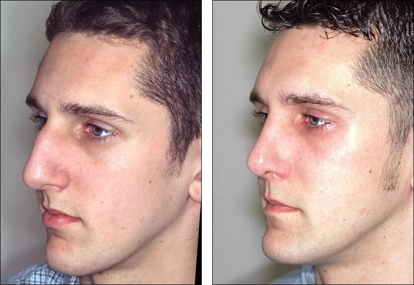 Как понять что нос сломан после удара. Ринопластика кривого носа. Септопластика искривление носовой перегородки. Как понять что нос сломан после удара. Как понять что нос сломан после удара.