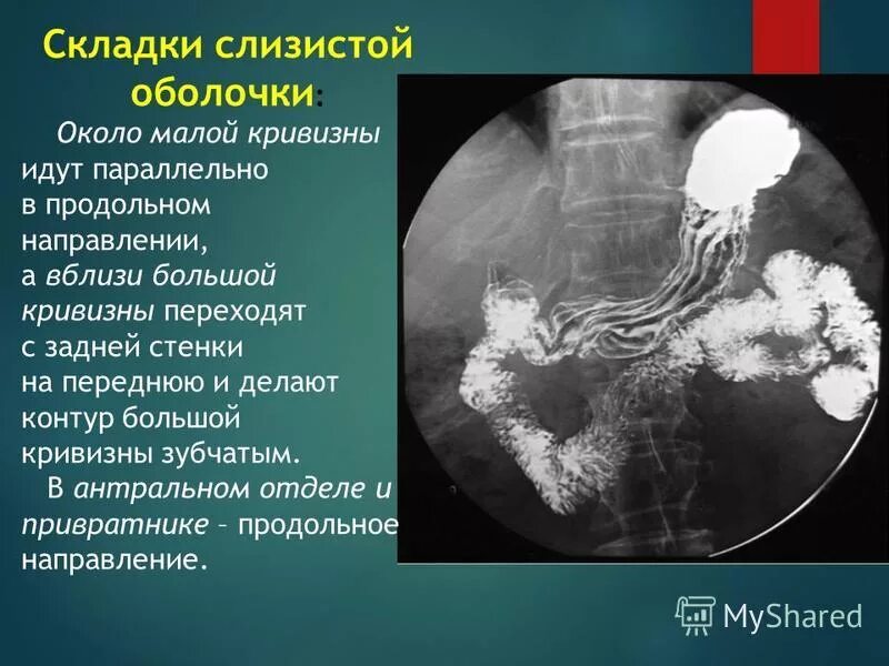 Продольные складки слизистой оболочки. Складки слизистой оболочки желудка рентген. Слизистая оболочка желудка складки. Складки слизистой оболочки на рентгене.