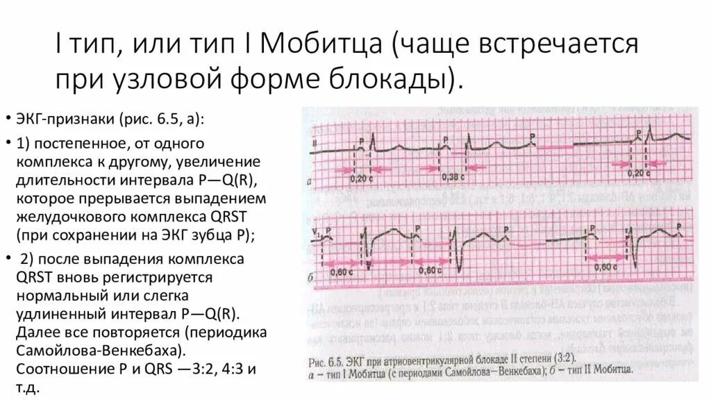 Заключение ЭКГ при АВ блокаде 2 степени. ЭКГ при АВ блокаде 3 степени. Атриовентрикулярная блокада 3 степени на ЭКГ. Лечение АВ блокады. Что значит av