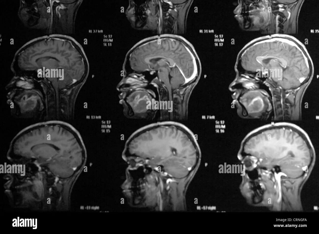 Опухоль мозга у собак. Опухоль головного мозга симптомы. MRI in multiple Myeloma. Опухоль мозга симптомы на ранней стадии у женщин. Признаки опухоли головного мозга симптомы.