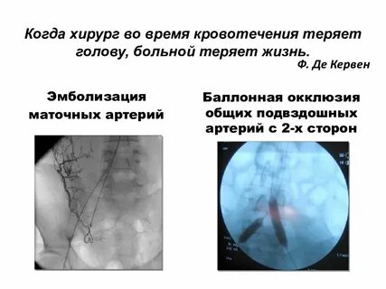 Эмболизация маточных артерий отзывы пациентов