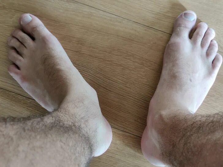 Продольное и поперечное плоскостопие 3 степени. Красивые коленки. Перелом 3 плюсневой кости стопы. Ноги без костей. Перелом медиальной лодыжки.