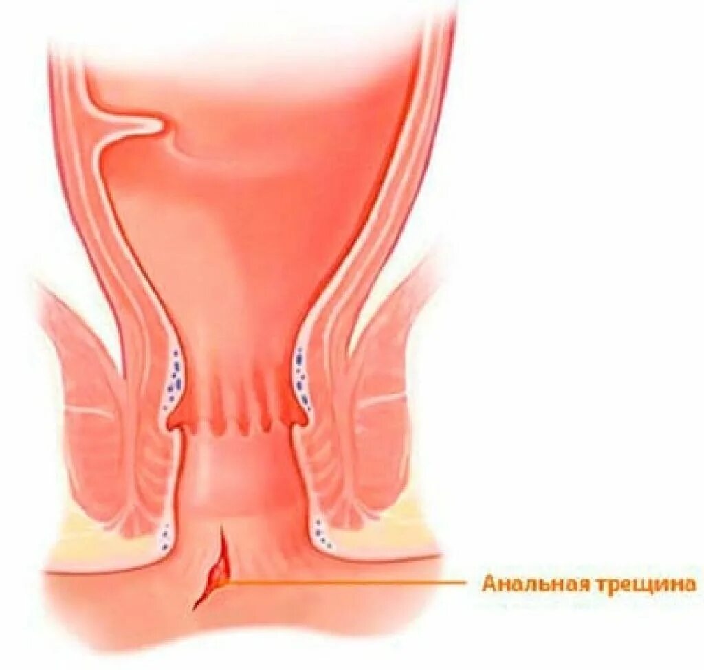 Трещина анального отверстия. Анальная трещина заднего прохода. Хроническая анальная трещина.