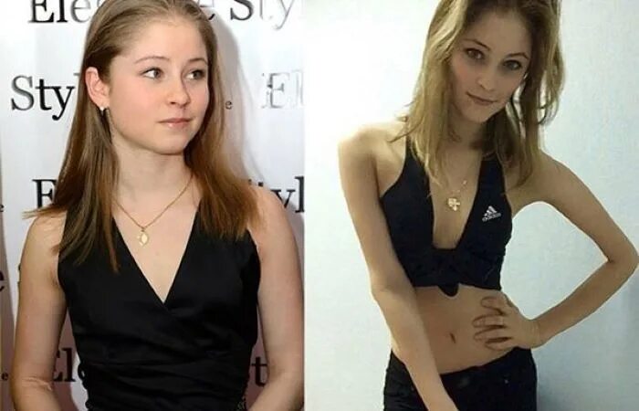 People who can overcome anorexia 2023 До После VK