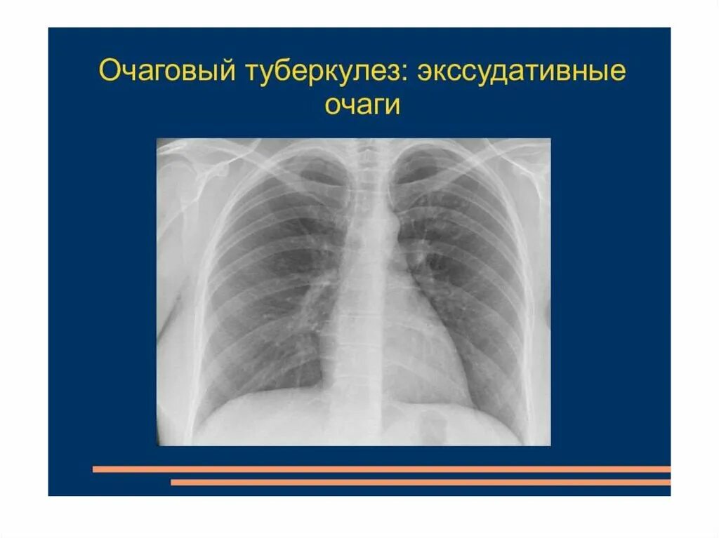 Очаговый туберкулёз лёгкого рентген. Очаговая форма туберкулеза рентген. Острый очаговый туберкулез рентген. Очаговый туберкулез описание рентгенограммы.