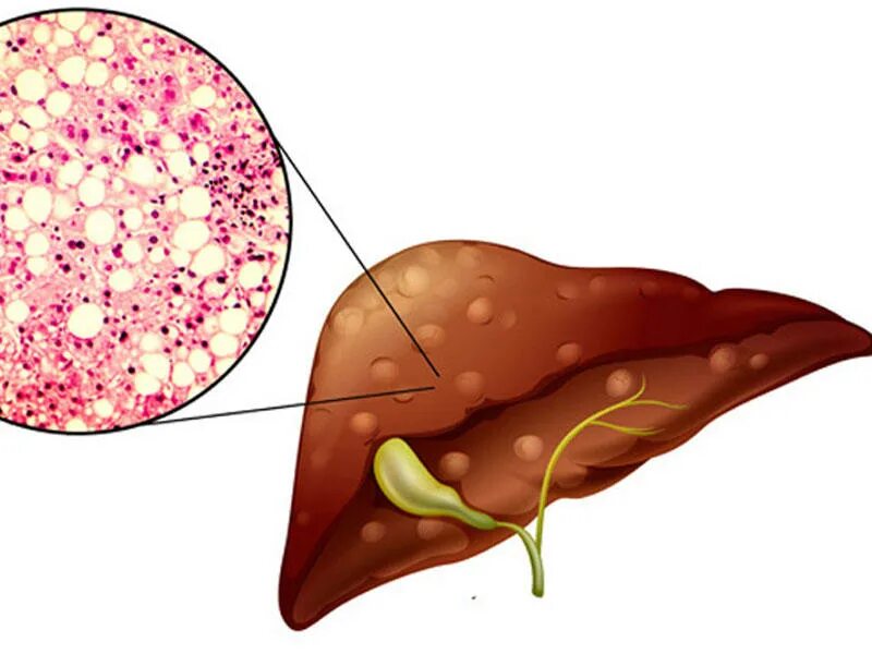 Печень больная жировой. Неалкогольный гепатоз. Тиреотоксический гепатоз. Жировой гепатоз печени. Болезнь печени жировой гепатоз.