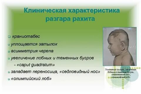 Рахит 5 месяцев