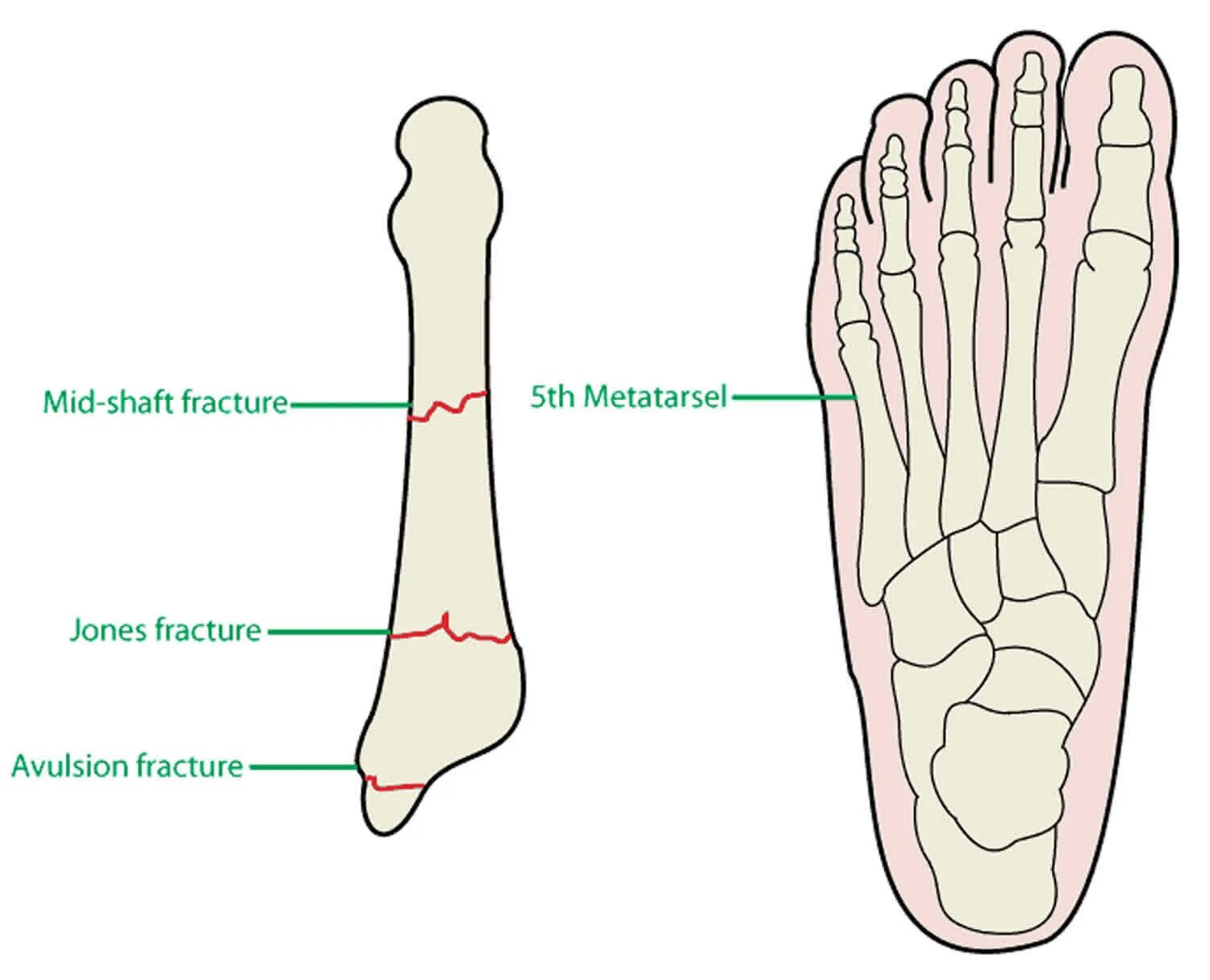 Перелом кости стопы сколько заживает у взрослых. 5 Плюсневая кость анатомия. Анатомия 5 плюсневой кости стопы. Плюсневая кость перелом Джонса.